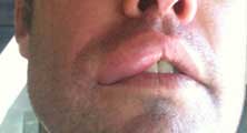 Los Angeles Bee Removal Guy Anthony picture of swelling after being stung 
    on the lip.